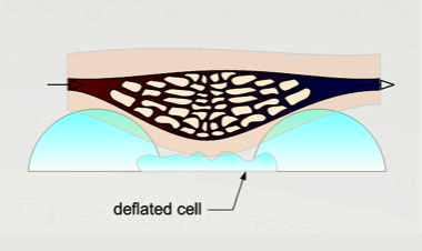 pressure sore, pressure ulcer, decubitus ulcer, alternating pressure mattress, mattress overlay, small cells, operating room ulcer prevention, pressure ulcer prevention, decubitus ulcer prevention, Medicare, Medicaid